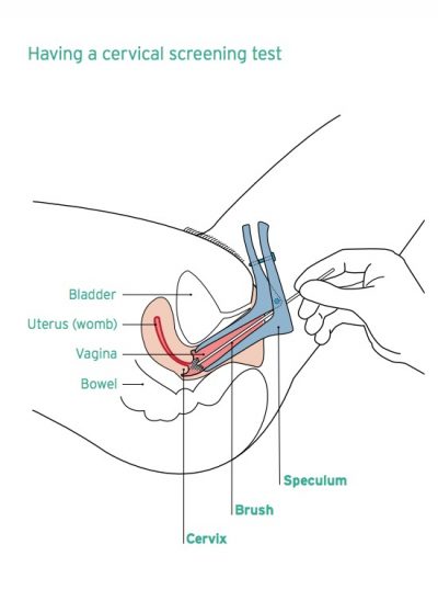 Cervical cancer Nhs